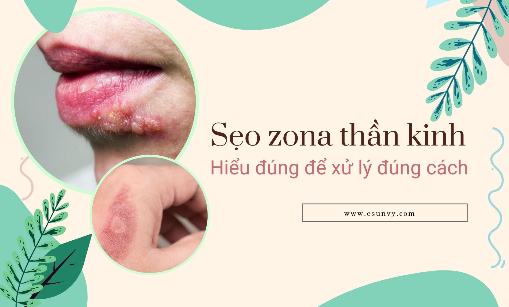 Zona thần kinh là gì?
