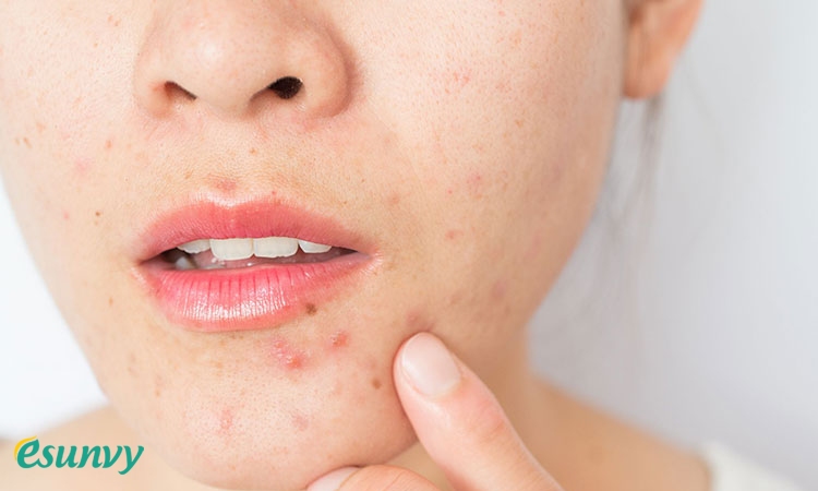 Các yếu tố nguy cơ khiến da khô dễ bị nổi mụn 1