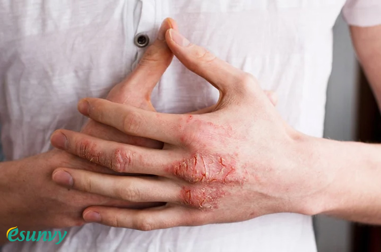 Da tay bị nứt nẻ chảy máu: Nguyên nhân, cách điều trị