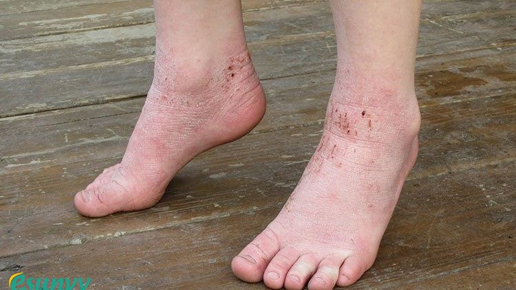 Da chân bị khô sần và ngứa nguyên nhân do đâu?
