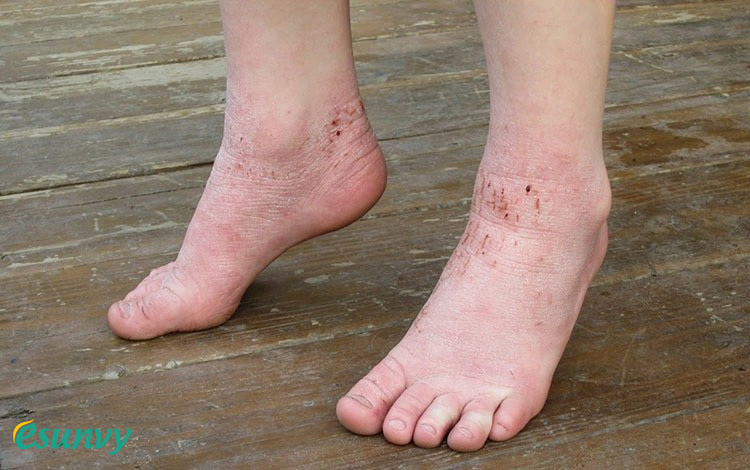 Đôi điều về tình trạng da chân bị khô sần và ngứa 1